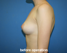 plastic-surgery-breast-augmentation